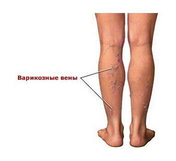 Варикозная болезнь Варикоз и целлюлит