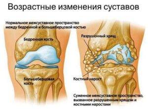 Артроз, Остеохондроз и т. д.